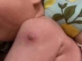 新生儿预防针化脓是正常现象吗？图片显示这种情况该如何处理？