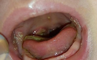 新生儿上颚小米粒白点是啥？