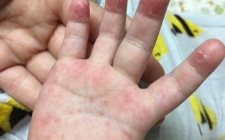 儿童手指真菌感染图片有哪些典型症状？如何正确辨别与处理？