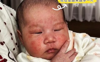新生儿脸上长满小红点，是湿疹还是过敏？该如何护理才正确？