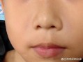 新生儿鼻子横纹图片是正常现象吗？需要担心健康问题吗？
