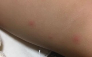 儿童大腿内侧大片红疹是何原因？