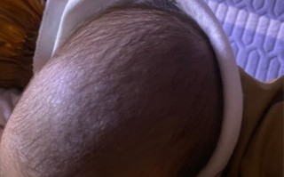 新生儿前囟门头发稀少是缺钙还是正常现象？