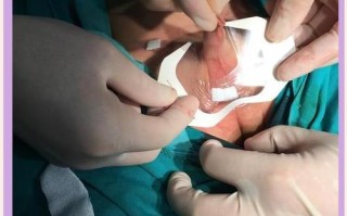 新生儿隐睾手术的成功率具体是多少？术后会影响生育功能吗？