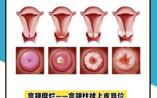 怀孕期宫颈糜烂影响胎儿健康吗？该如何安全治疗与护理？