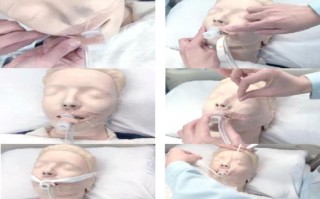 新生儿气管插管固定如何避免移位与皮肤损伤？