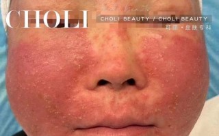 孕期激素脸反反复复，到底该怎么安全护理才能好？