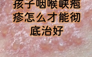 儿童口腔疱疹几天能好