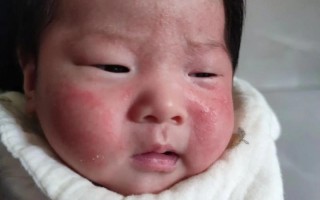 儿童脸上湿疹为何反复发作？日常护理与治疗需注意哪些关键点？