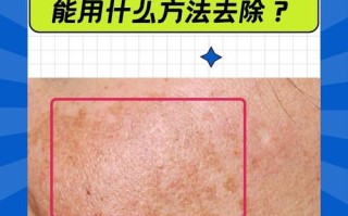 怀孕期间长斑能安全消除吗？对胎儿有影响吗？