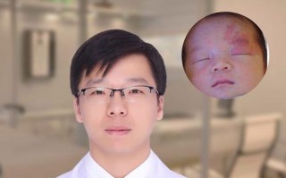 新生儿葡萄酒色斑图片