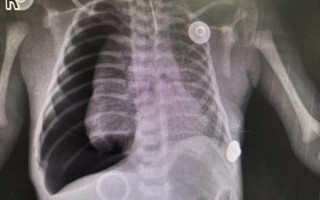 新生儿乳糜胸胸腔积液，病因、诊断与治疗全解析