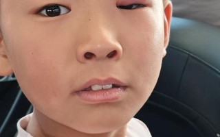 新生儿麦粒肿反复发作怎么办？家庭护理能自行消除吗？