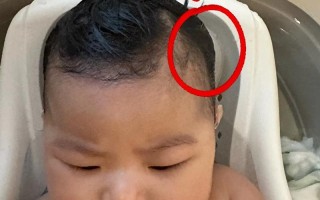 新生儿前额两边没头发