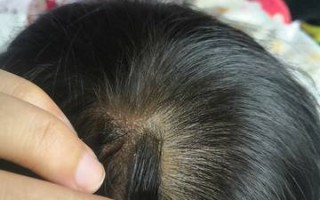 新生儿头发上出现白色点点是正常现象还是疾病信号？