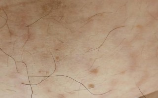 孕期身上突然长很多扁平疣，会对胎儿有影响吗？需要治疗吗？