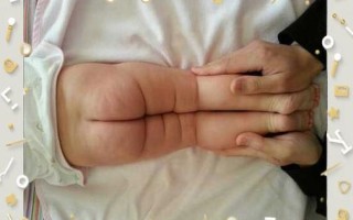 新生儿双腿纹不对称是发育异常信号吗？需要警惕哪些潜在问题？