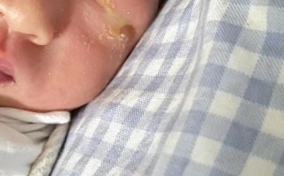 新生儿一只眼流泪有眼屎怎么办？