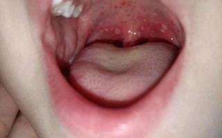 儿童嗓子起小泡是手足口病吗？需要怎么处理？