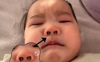 新生儿长鼻屎是正常现象还是生病信号？家长该如何正确处理？