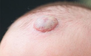 新生儿头上摸到硬筋疙瘩是正常现象吗？需要担心吗？