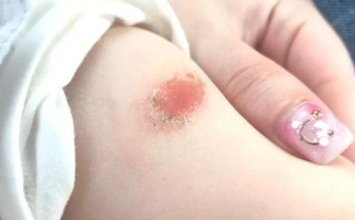 新生儿打疫苗后起脓包是正常反应吗？需要处理吗？