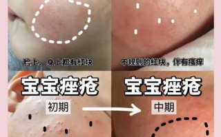 新生儿痤疮和湿疹的区别到底在哪里？家长该如何准确区分并科学护理？