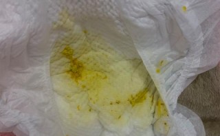 新生儿黄疸期间拉黄屎是正常现象还是需要警惕的信号？