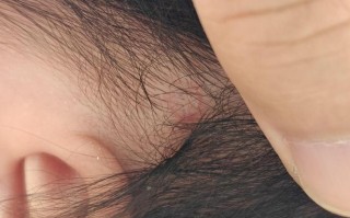 新生儿头皮小红点是湿疹还是痤疮？如何正确护理与区分？