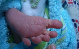 新生儿挤压综合征有哪些典型表现？家长该如何早期识别与应对？