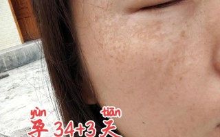 孕期脸上长斑太烦人？有哪些科学方法能帮准妈妈有效预防？