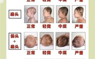 新生儿额头突出是正常发育现象还是需要警惕的异常情况？