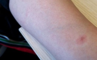 孕期得了丘疹性荨麻疹，宝宝会受影响吗？该怎么安全治疗？