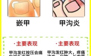 怀孕期间甲沟炎反复发作，对胎儿有影响吗？该怎么安全处理？