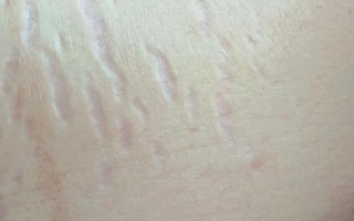 孕期如何不长妊娠纹？