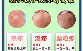 新生儿热疹究竟是如何引起的？是环境过热还是护理不当导致的？