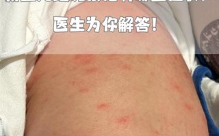 新生儿红斑图片显示症状，该如何科学治疗与护理？