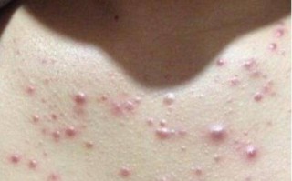 孕期胸前长痘真能预示宝宝性别？男孩女孩和痘痘位置、形态有关联吗？