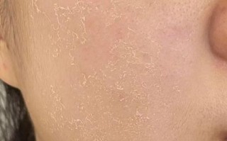 怀孕期间面部干燥脱皮是缺水还是激素变化导致的？