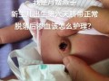 新生儿脐带脱落后出血怎么办？需要立即就医还是在家观察处理？