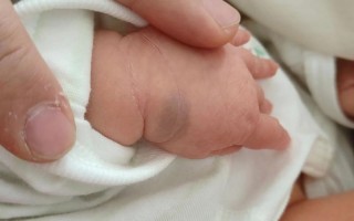 新生儿手腕血管瘤会自行消退吗？需要治疗吗？家长该如何护理？