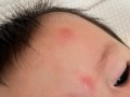 新生儿被蚊子咬起红点咋处理？