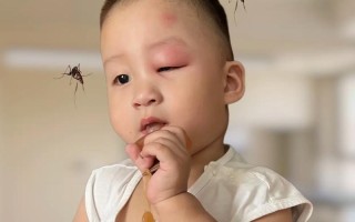未满月新生儿被蚊子咬了怎么办？能用药吗？如何正确处理？