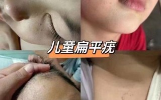 儿童病毒性疣早期图片有哪些典型特征？如何与普通皮疹区分？