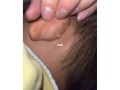 新生儿耳朵后面出现疙瘩，是正常生理现象还是需要警惕的异常信号？