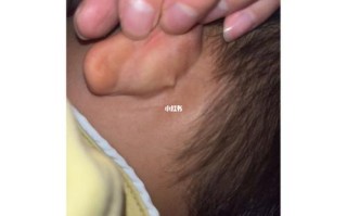 新生儿耳朵后面出现疙瘩，是正常生理现象还是需要警惕的异常信号？