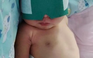 新生儿出生四天黄疸18mg/dL需要立即干预吗？