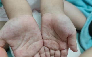 新生儿手上有红点图片是湿疹还是过敏？需要担心吗？