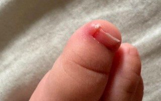 新生儿为什么会出现甲沟炎？这究竟与哪些因素有关？