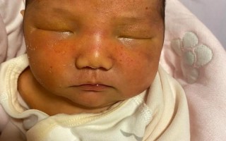 新生儿晒黄疸脸晒红了，晒黄疸的正确方法和注意事项是什么？